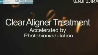 Clear Aligner Treatment Accelerated by Photobiomodulation