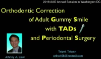 Orthodontic Correction of Adult Gummy Smile with TADs and Periodontal Surgery